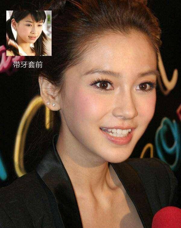 明星的牙套之旅，友情与温馨的故事