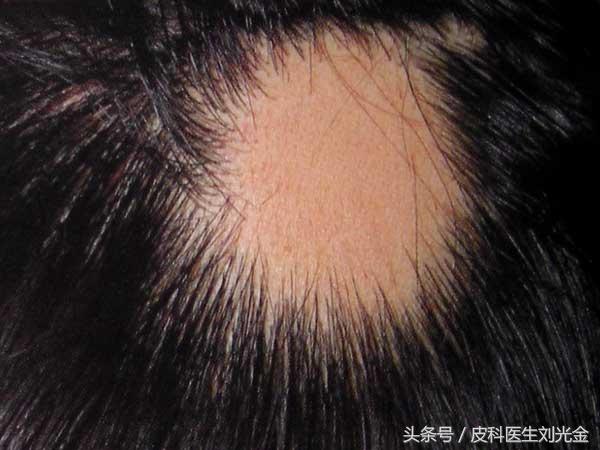 普秃最新治疗技术，科技助力重塑自信魅力生活