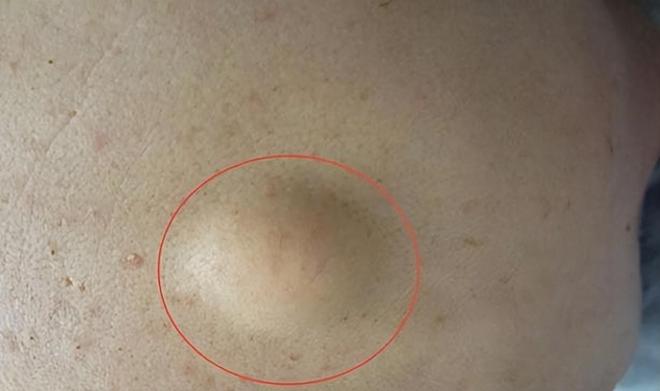 多发性脂肪瘤最新研究进展及研究成果概述